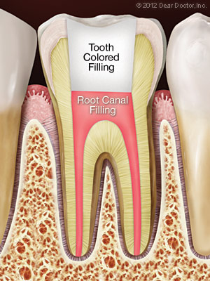 Root canal treatment with tooth-colored filling