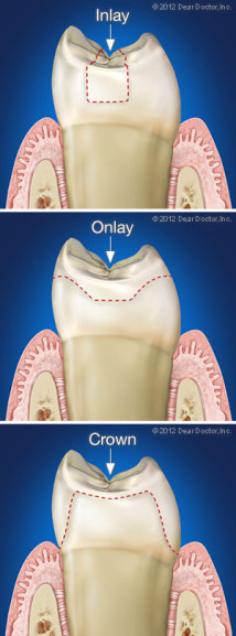 Dental inlay and onlay compared to a crown