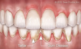 gum disease plaque and tartar buildup 