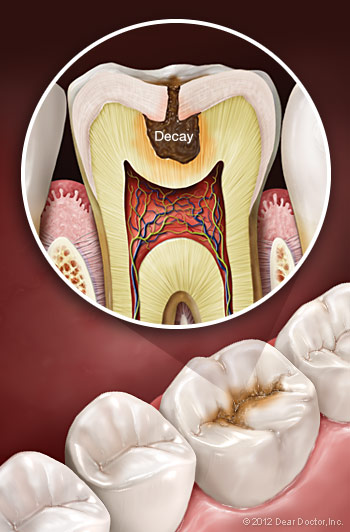 Anatomy of tooth decay 