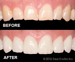 Before and after of dental veneer procedure