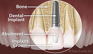 Anatomy of a dental implant with an implant crown