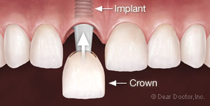 Dental Veneers of Celeb Jaws Health