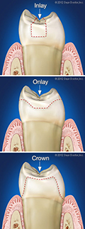 Inlays Onlays and Crowns Dentist Lancaster CA